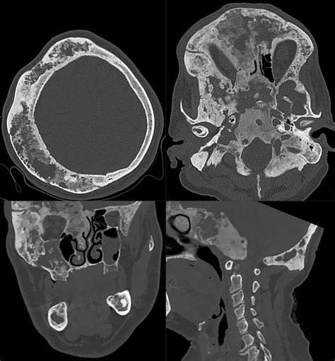 Fibrous Dysplasia Skull Bone Scan