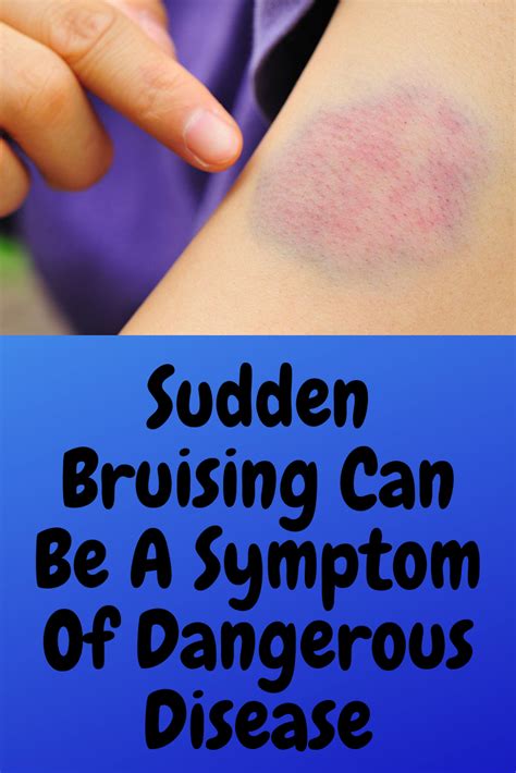 Sudden Bruising Can Be A Symptom Of Dangerous Disease Symptoms