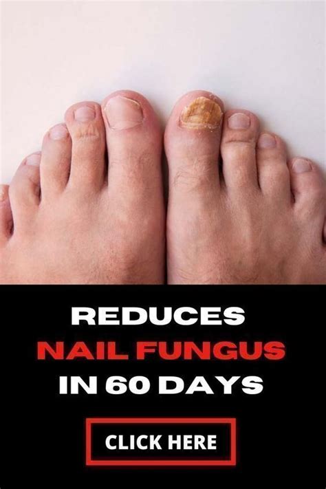 People Go Crazy For This Remedy To Fix Nail Fungus Artofit