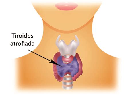 Doenças da tireoide causas e sintomas Melhor saúde