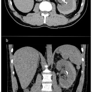 PDF Subcapsular Hematoma After Ureteroscopy And Laser Lithotripsy