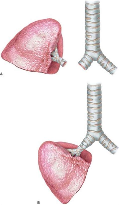 Right Lower And Middle Lobe Sleeve Lobectomy Master Techniques In