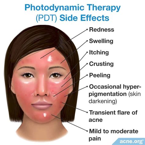 Blue Light Photodynamic Therapy For Precancerous Lesions Shelly Lighting