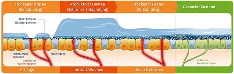 Symptome Einer Akuten Bronchitis