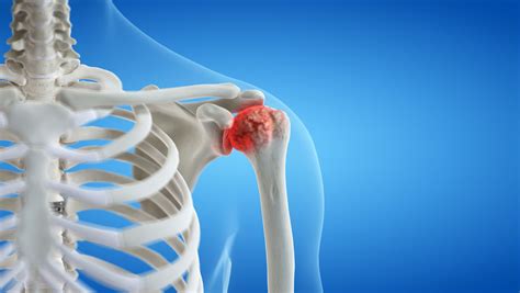 Shoulder Arthritis What Is It Symptoms Treatment And Prevention