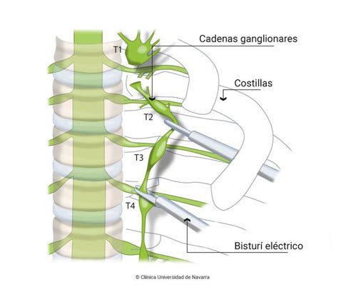 Cirugía endoscópica para la hiperhidrosis Clínica U Navarra