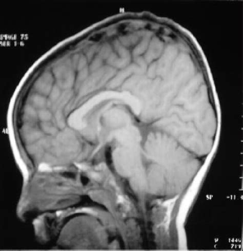 Normal Brain Magnetic Resonance Imaging Findings With Intact Corpus