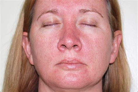 Rosacea Symptoms And Treatments Mama Nature