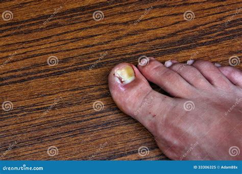 Swollen Ingrown Toe Royalty Free Stock Photo Image 33306325