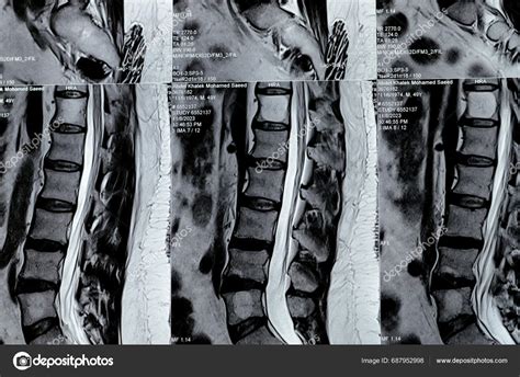 Cairo Egypt November Mri Lumbosacral Spine Revealed Posterior Disc