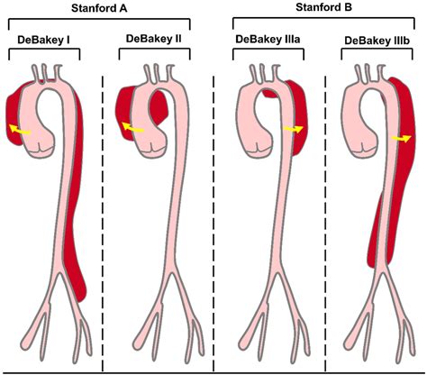 Debakey And Stanford Classifications Of Ad The Debakey Classification