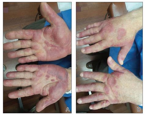 Sweet Syndrome With Marked Eosinophilic Infiltrate Mdedge Dermatology