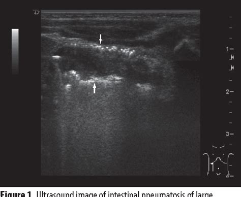 Necrotizing Enterocolitis Ultrasound