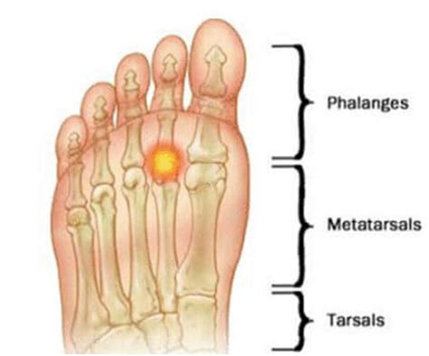 Condition Spotlight Synovitis Watsonia Podiatry