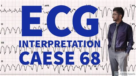 ECG MADE EASY CASE 68 ATRIAL FIBRILLATION WITH ABBARENCY ECG EKG