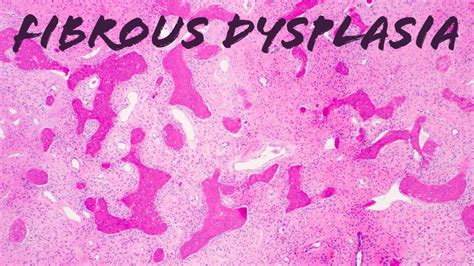 Fibrous Dysplasia Bone Pathology Histology McCune Albright Syndrome