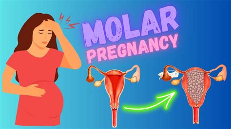 Molar Pregnancy Hydatiform Mole Risk Factors Types Symptoms