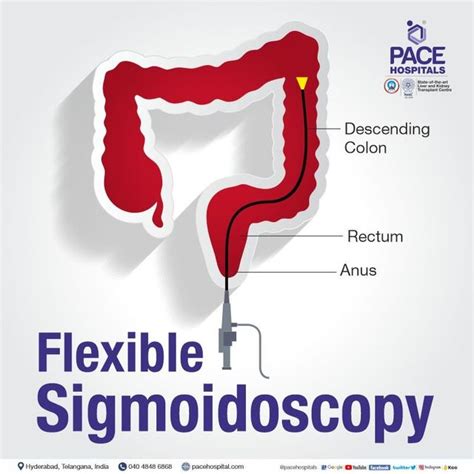 Sigmoidoscopy Procedure