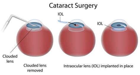 Cataracts Diagram