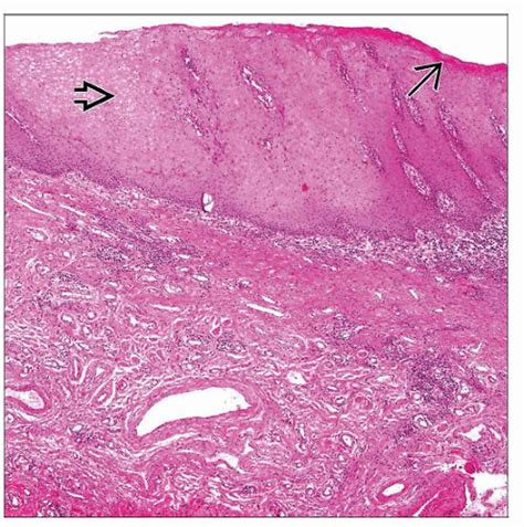 Squamous Hyperplasia Basicmedical Key