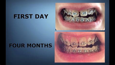 Braces Months Time Lapse Braces Progress Youtube