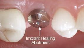 Healing Abutment Care Charleston SC