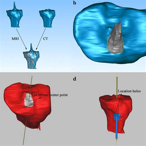 Comparison Of The Acl Tibial Attachment Area And Its Center Point A On