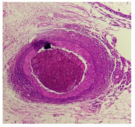 Fibrinoid Necrosis Polyarteritis Nodosa