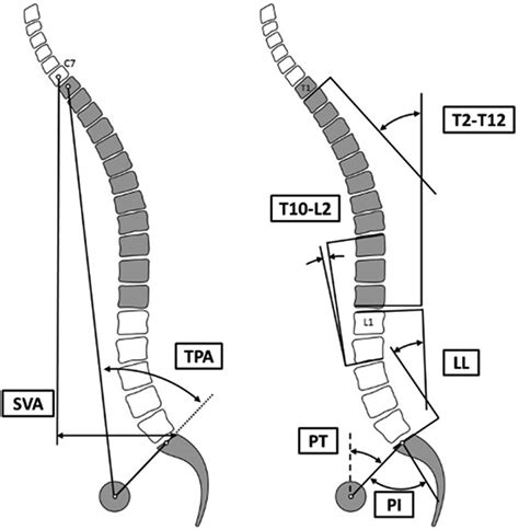 How Much Lumbar Lordosis Does A Patient Need To Reach Their Age