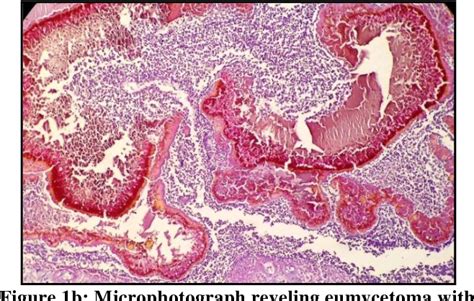 Figure From Eumycetoma On Histopathology Presenting At Unusual Site