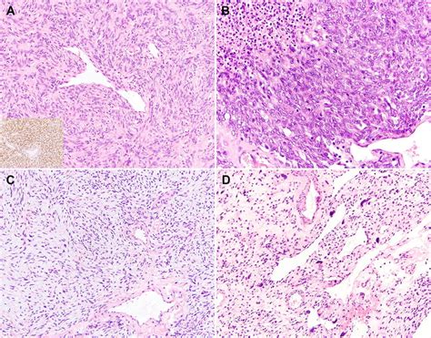 A Solitary Fibrous Tumor Sft Composed Of Short Spindle Cells With A