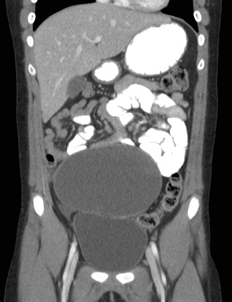 Large Prepubertal Ovarian Cyst Bmj Case Reports