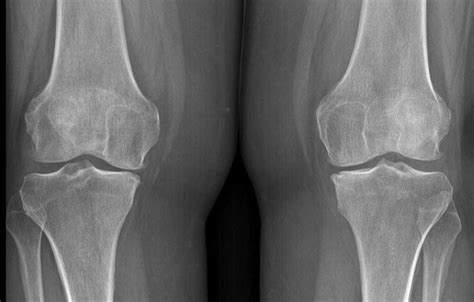 Regenerative Orthopedic Case of the Week: 5 year history of bilateral knee pain – Steve Meyers, MD