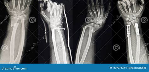 Collection Of Human X-rays Showing Multiple Hand Fracture. Stock Photography | CartoonDealer.com ...