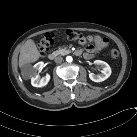 Hemorrhagic Renal Cyst Masquerading As Bosniak 4 Mass Lesion Ceus Image