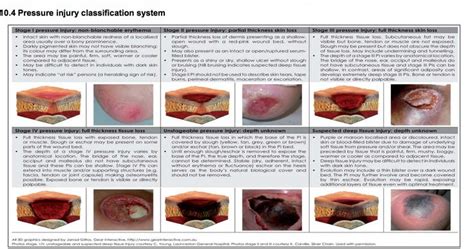 Pressure Ulcer Classification