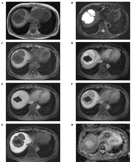 Liver Hemangioma Mri Enhancement