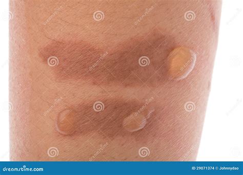 Burn Blisters On The Skin Stock Photo Image Of Accident 29071374