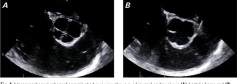 Figure 1 From Quadricuspid Aortic Valve Imaging Diagnosis And