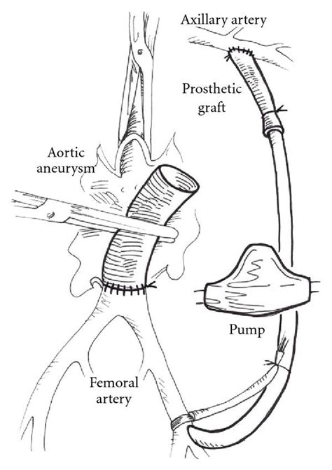 A Construction Of Axillofemoral Bypass With A Centrifugal Pump In The Download Scientific