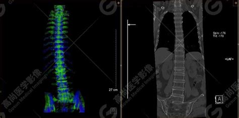 双源ct骨髓成像在脊柱骨折鉴别诊断中的应用分析 知乎