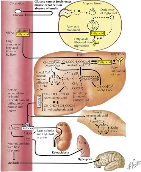 Diabetic Ketoacidosis Obgyn Key