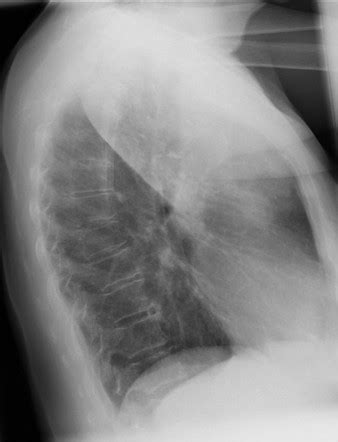 Left Upper Lobe Consolidation Radiology Reference Article