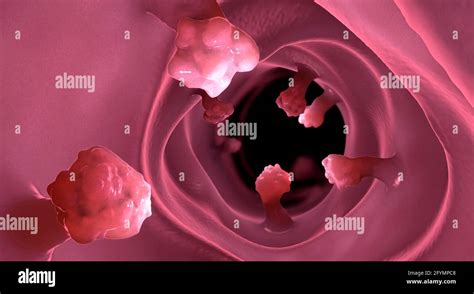 Intestinal polyps, illustration Stock Photo - Alamy