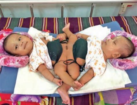 Parents Of Conjoined Twins Seek Donations For Separation Surgery Coconuts