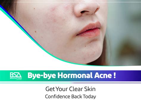 Hormonal Acne And The Best Effective Methods For Treatment