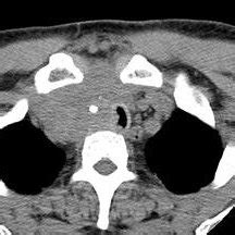 A The Pet Ct Image Shows An Increase In Fdg Uptake In The Mediastinum