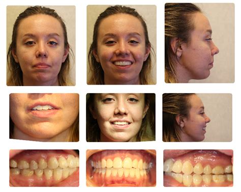 TMJ Replacement Surgery Naperville Joliet Yorkville IL