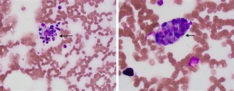 Frontiers Case Report A Unique Case Of Secondary Hemophagocytic