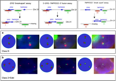 Fish Analysis Of The Tmprss And Erg Loci In Edel Cancers The Left